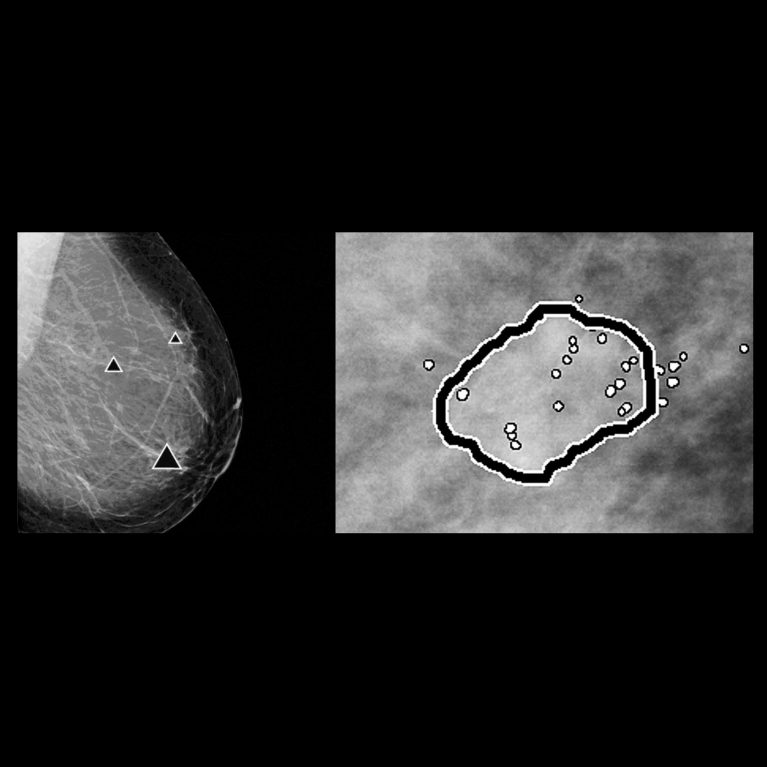 Post–Vacuum-Assisted Stereotactic Core Biopsy Clip Displacement: A  Comparison between Commercially Available Clips and Surgical Clip